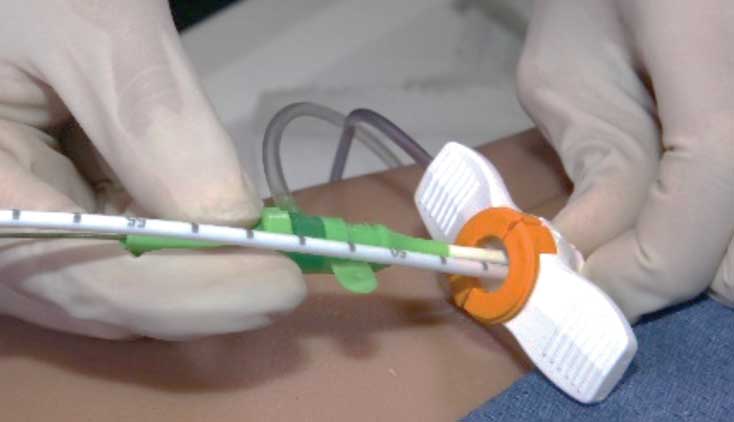 MEDCERT ermöglicht in Europa die Anwendung des Single-Access Verfahrens mit Impella CP Einführschleusen Blog Image