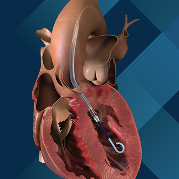 Illustration of an Impella CP with SmartAssist in the left ventricle of a heart on a navy blue background with a hash pattern